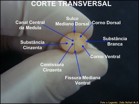 En qué consiste un trasplante de médula